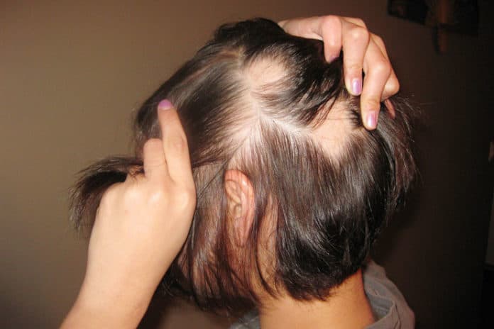 A montanha-russa chamada Alopecia Areata